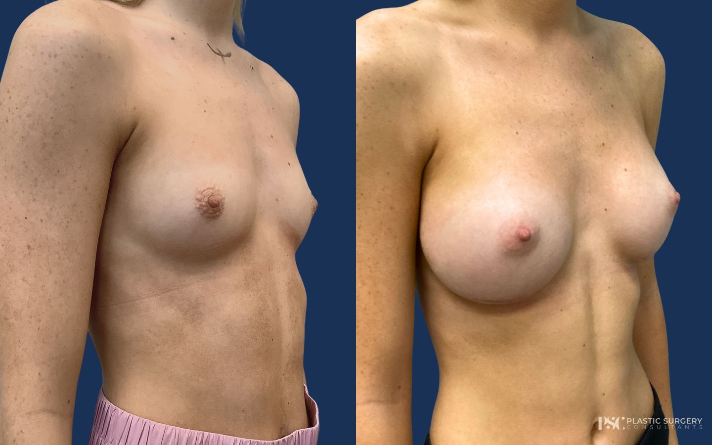 Before and after Breast Augmentation case 23870 - Angle 2