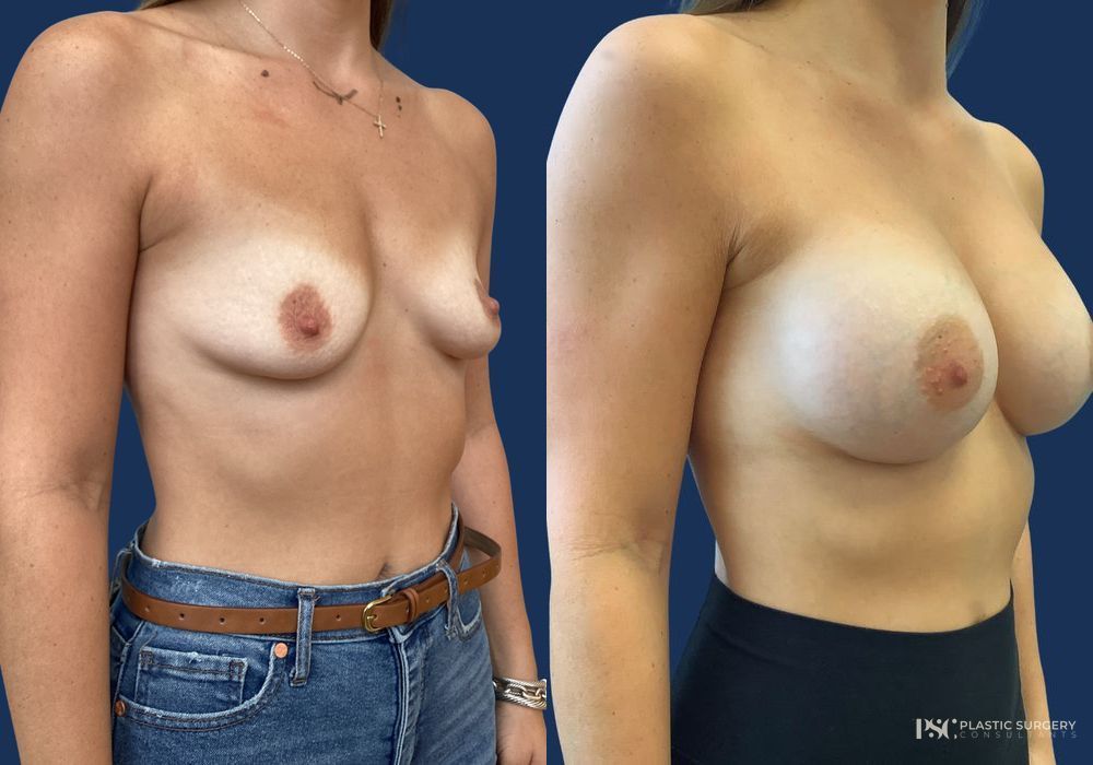 Before and after Dr. Richard J. Wassermann case 23867 - Angle 2
