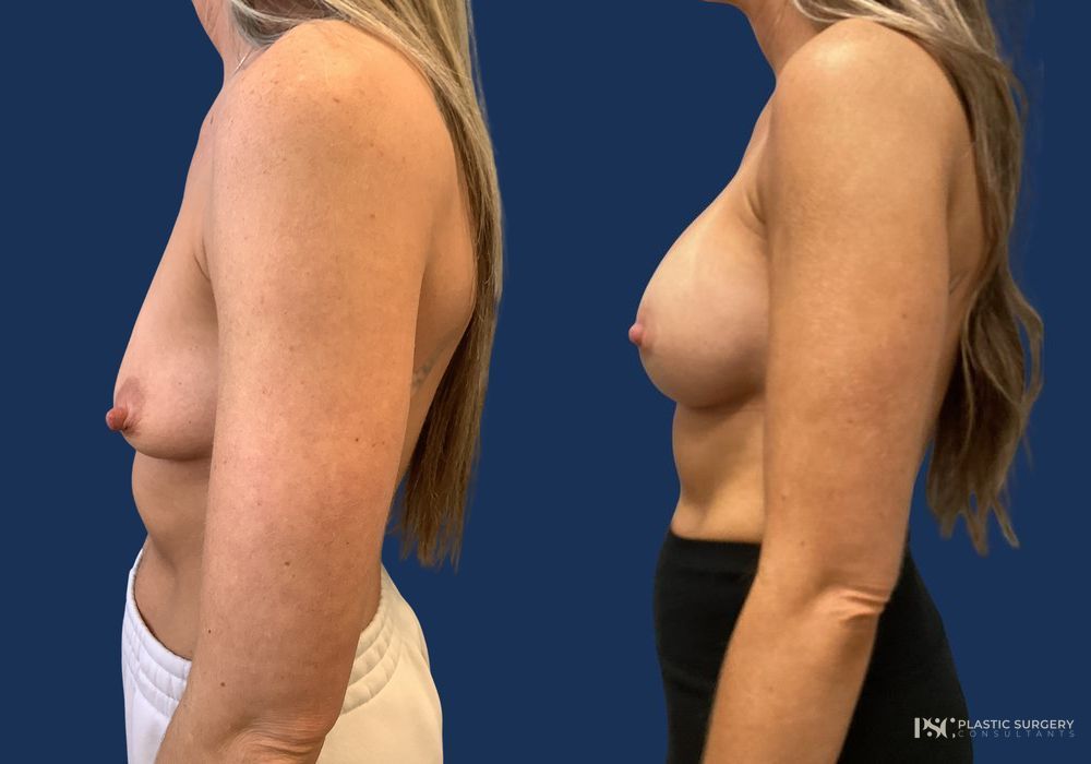 Before and after Dr. Richard J. Wassermann case 26245 - Angle 2
