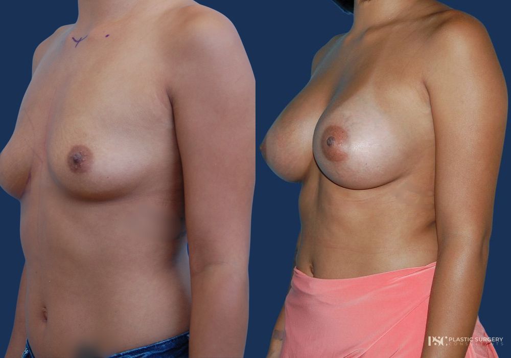 Before and after Dr. Richard J. Wassermann case 23869 - Angle 2
