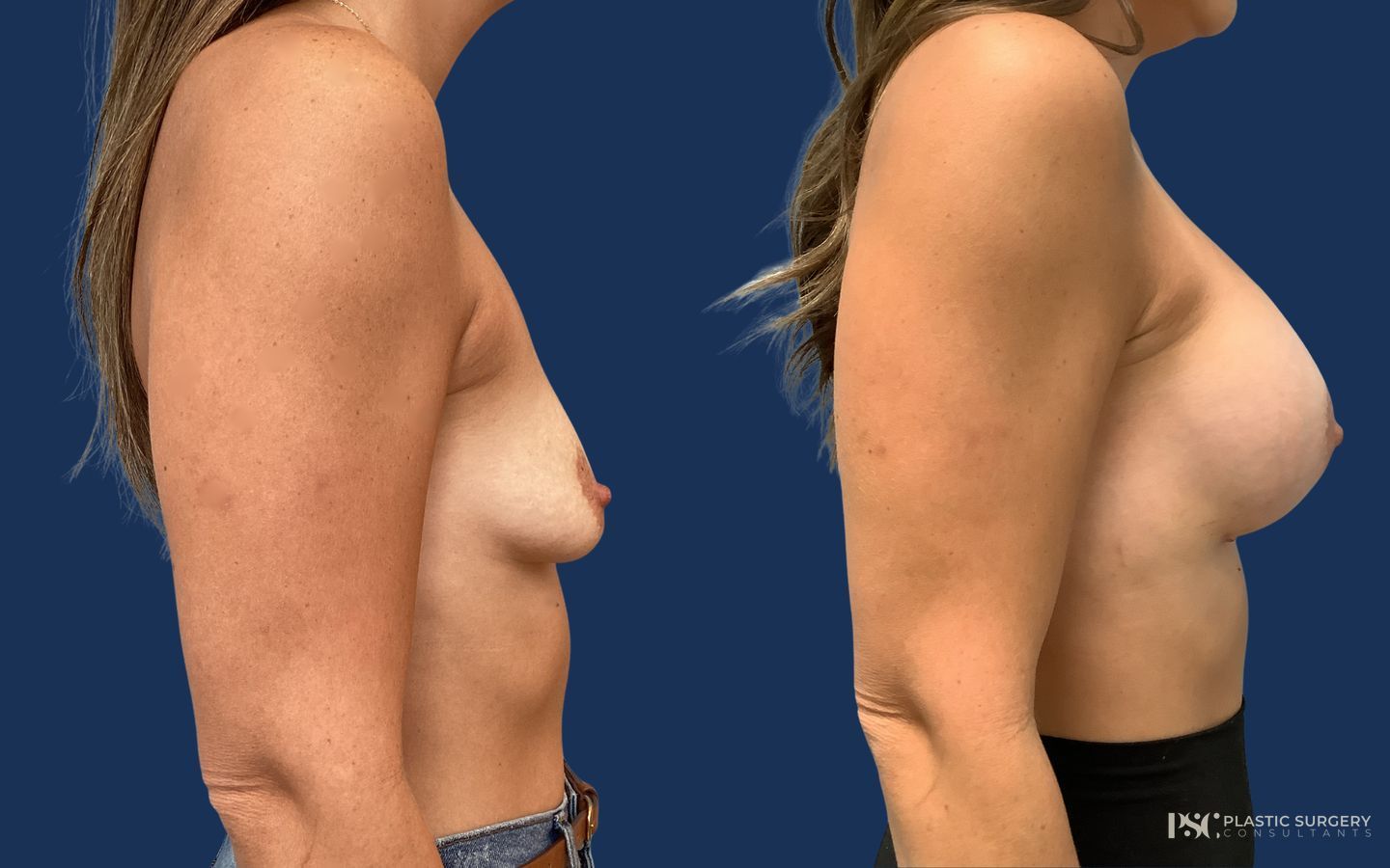 Before and after Breast Augmentation case 23867 - Angle 3