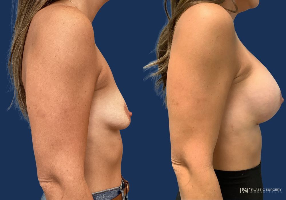 Before and after Dr. Richard J. Wassermann case 23867 - Angle 3