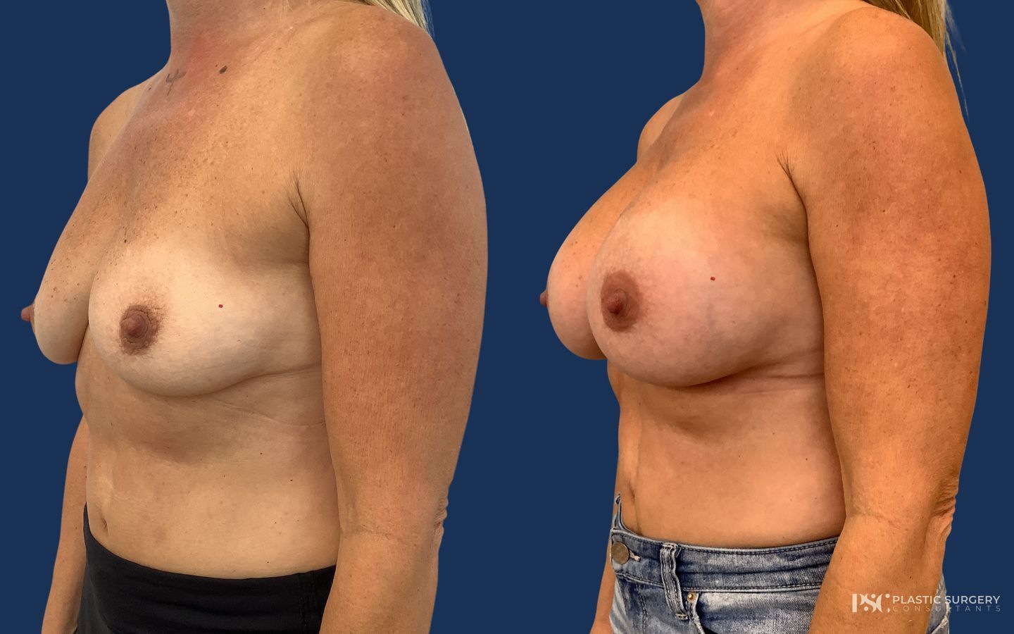 Before and after Breast Augmentation case 23868 - Angle 2