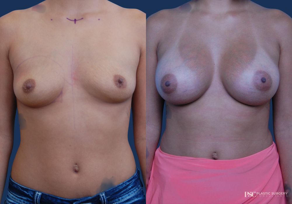 Before and after Dr. Richard J. Wassermann case 23869