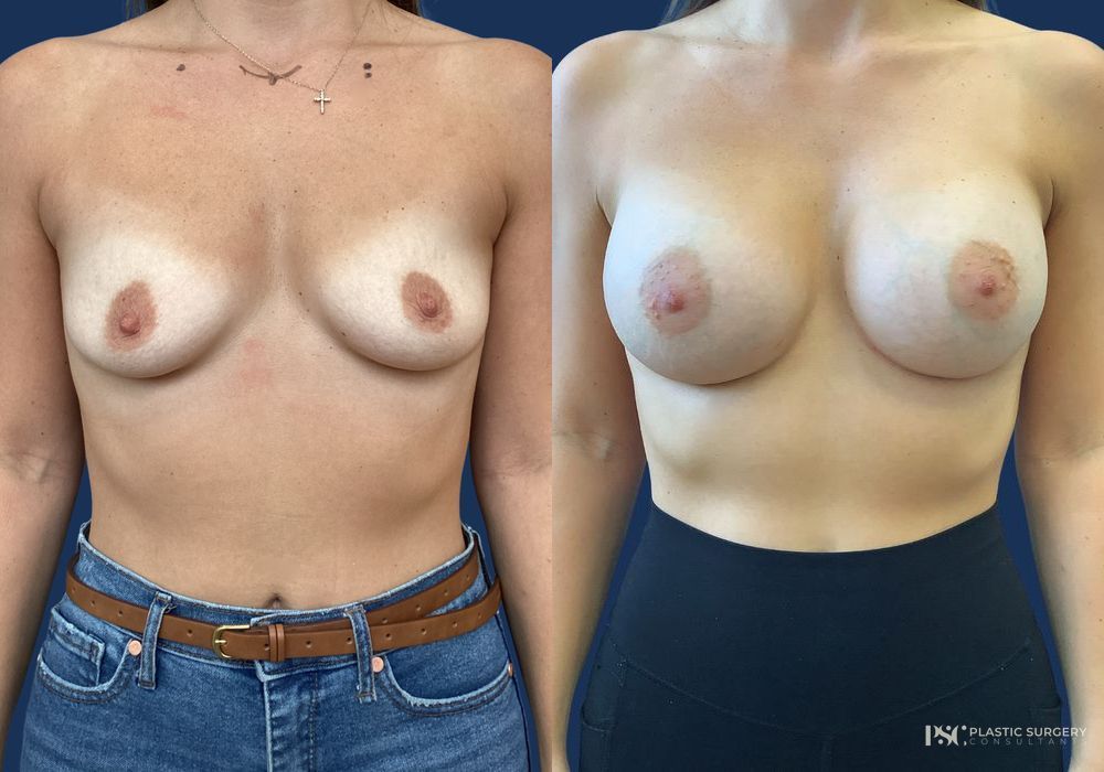 Before and after Dr. Richard J. Wassermann case 23867