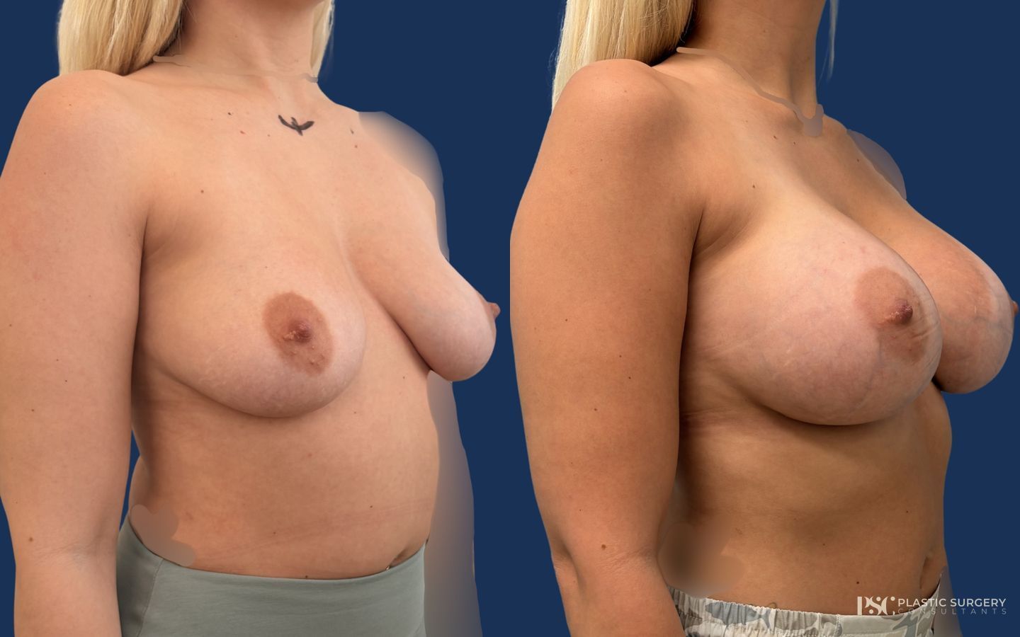 Before and after Breast Augmentation case 46025 - Angle 2