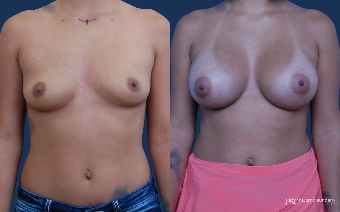 Before and after Breast Augmentation case 23869