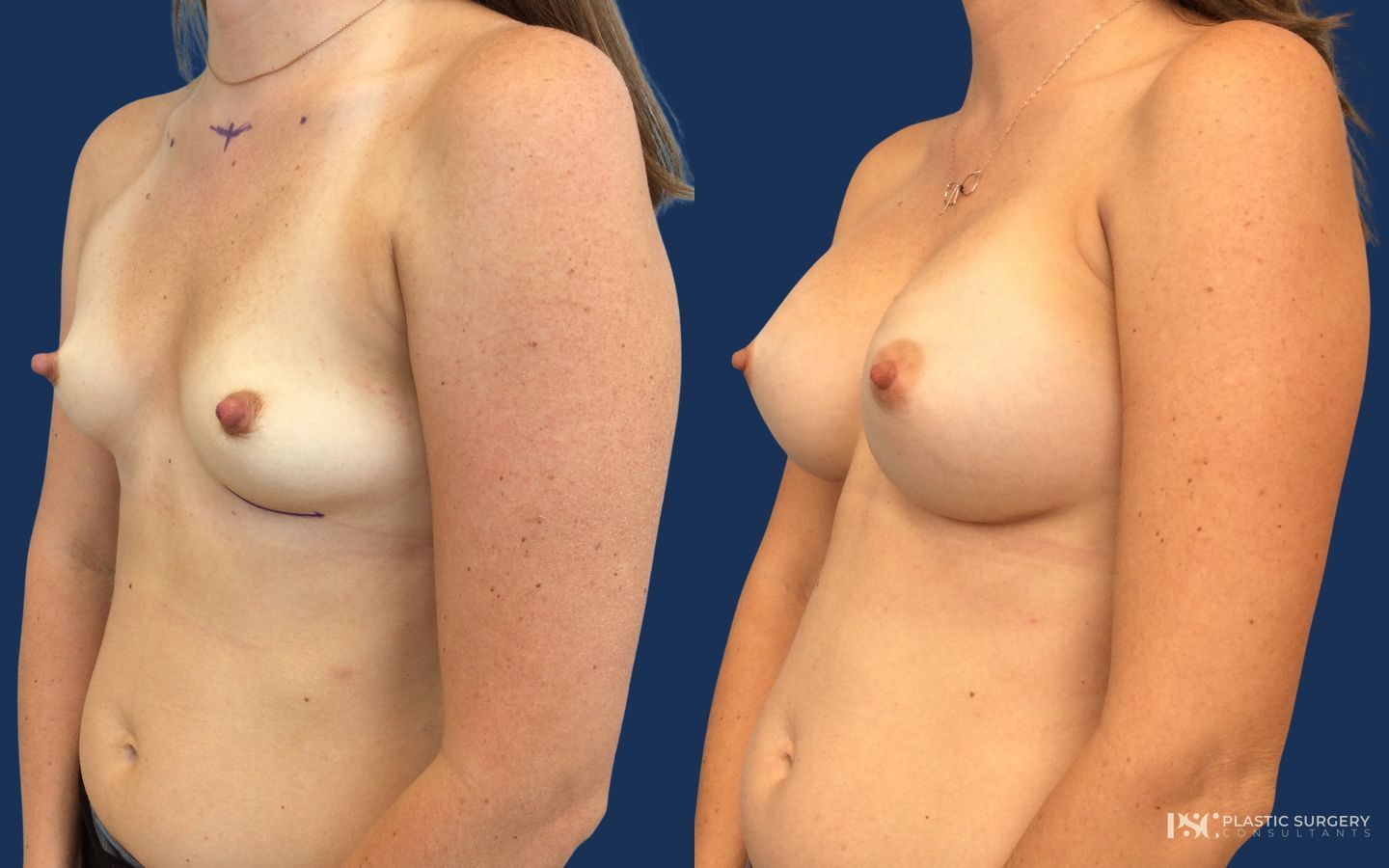 Before and after Breast Augmentation case 23873 - Angle 2