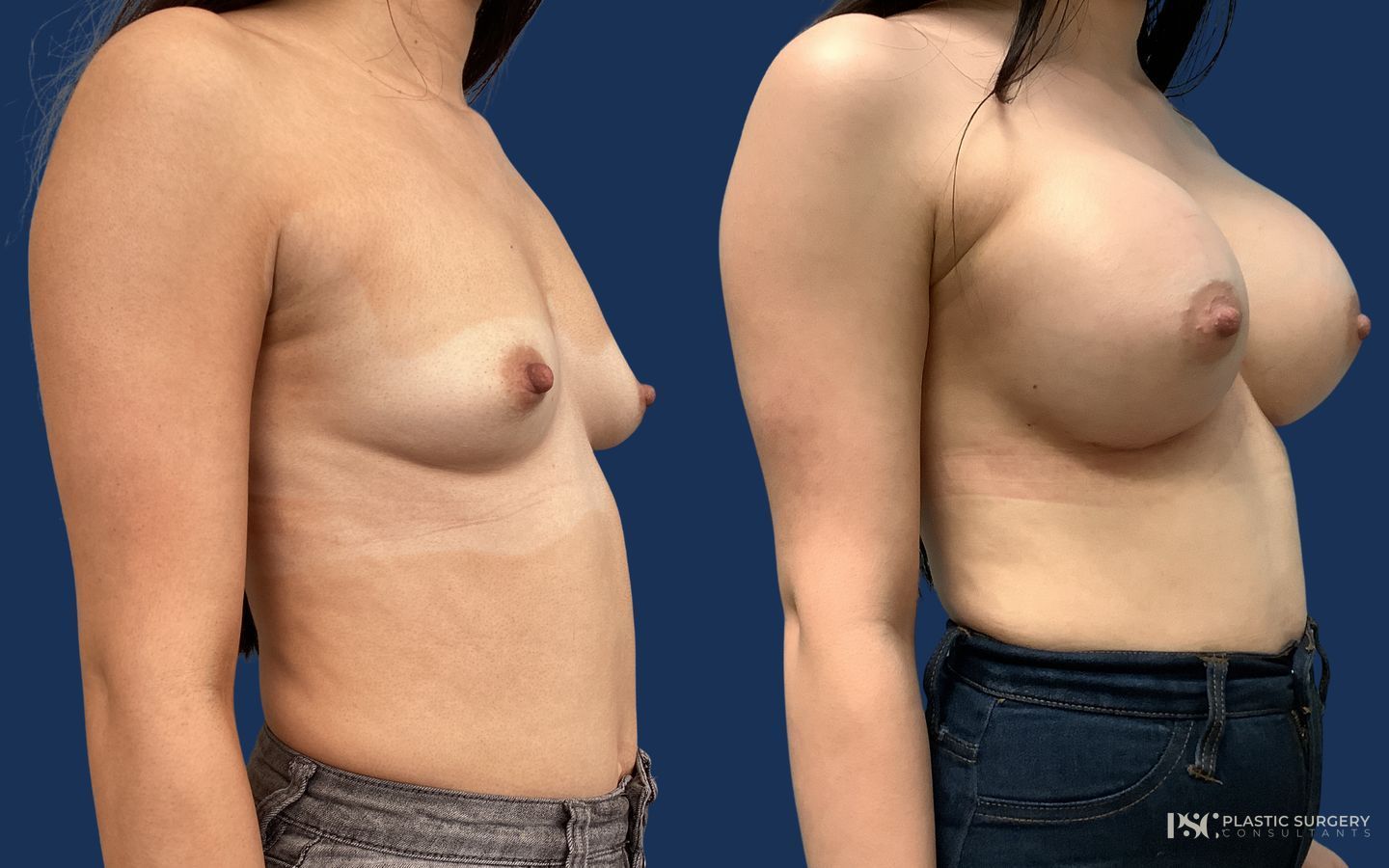 Before and after Breast Augmentation case 23871 - Angle 2