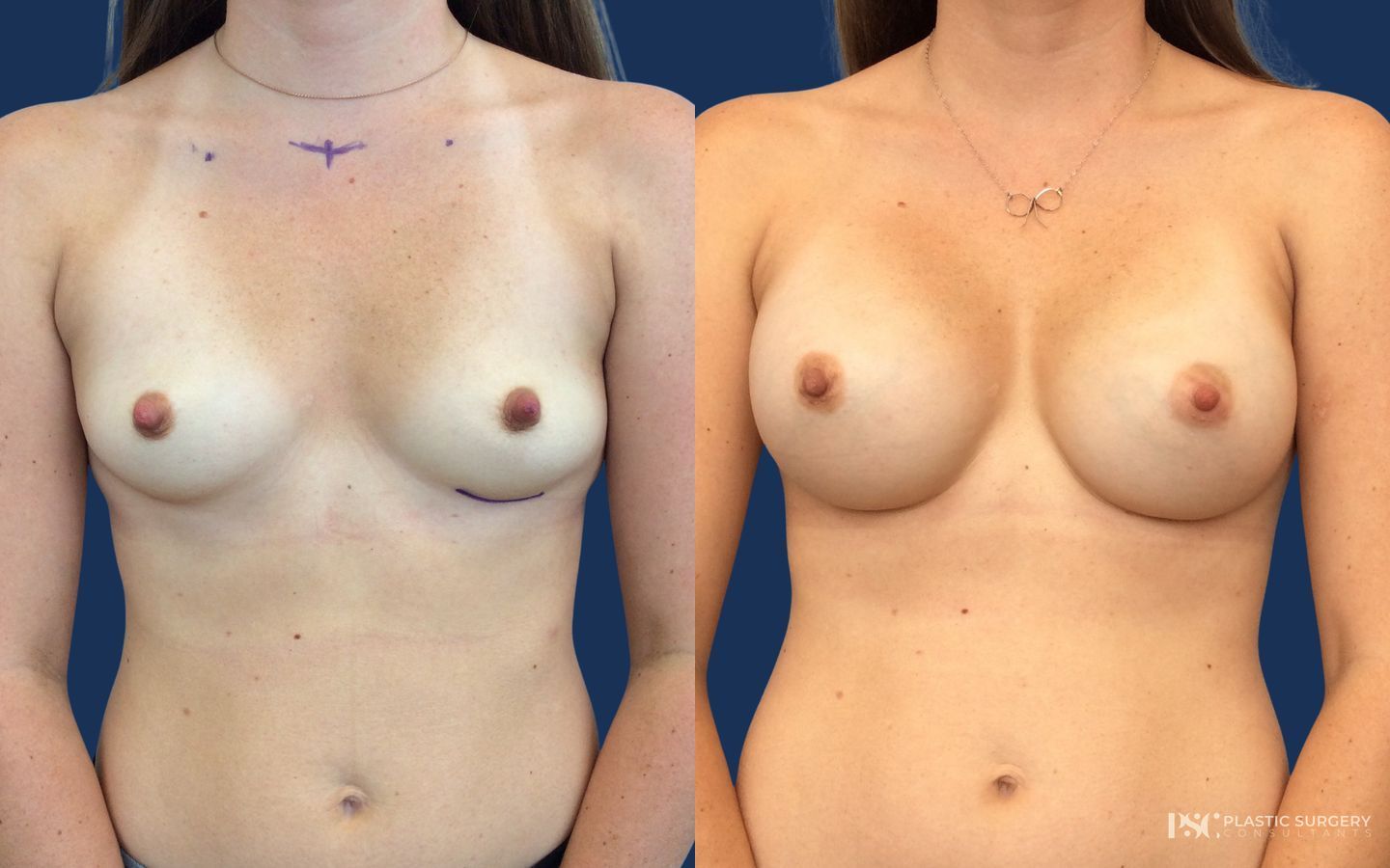 Before and after Breast Augmentation case 23873
