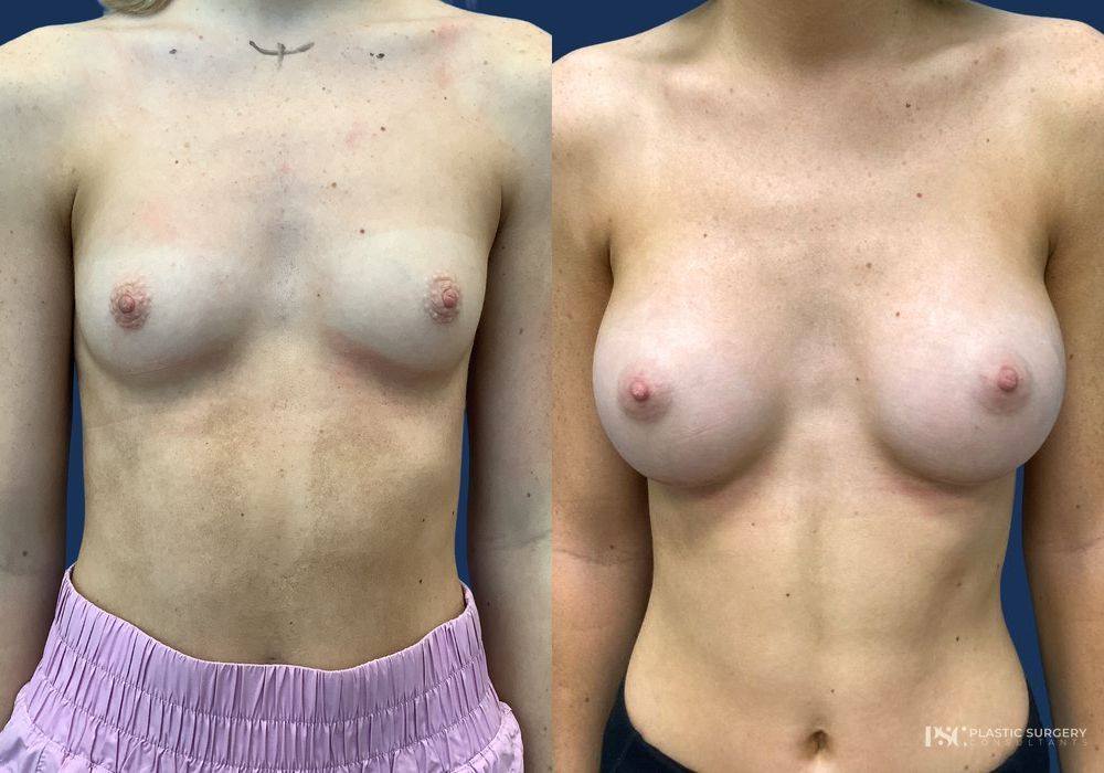 Before and after Dr. Richard J. Wassermann case 23870