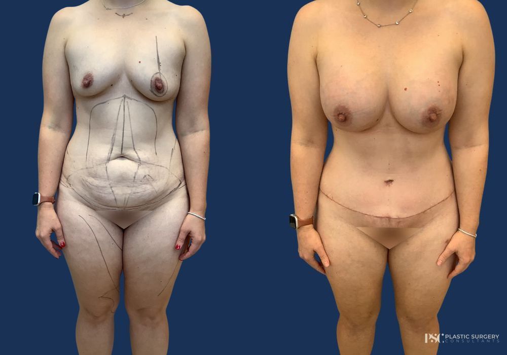 Before and after Dr. Richard J. Wassermann case 26915