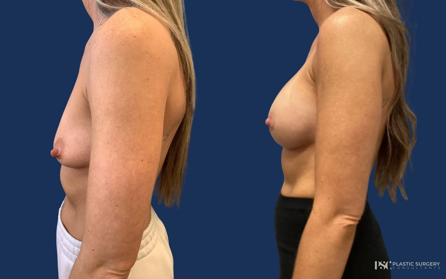 Before and after Breast Augmentation case 26245 - Angle 2