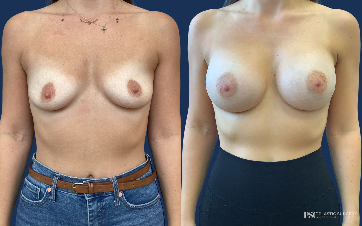 Before and after Breast Augmentation case 23867