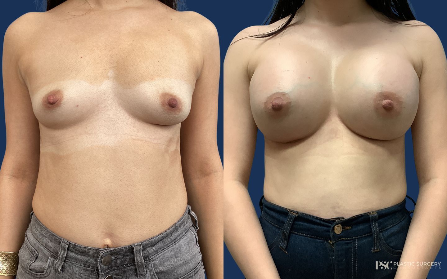Before and after Breast Augmentation case 23871