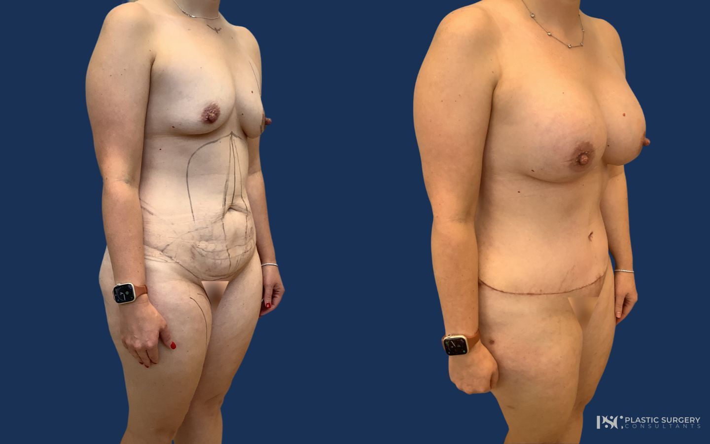 Before and after Breast Augmentation case 26915 - Angle 2