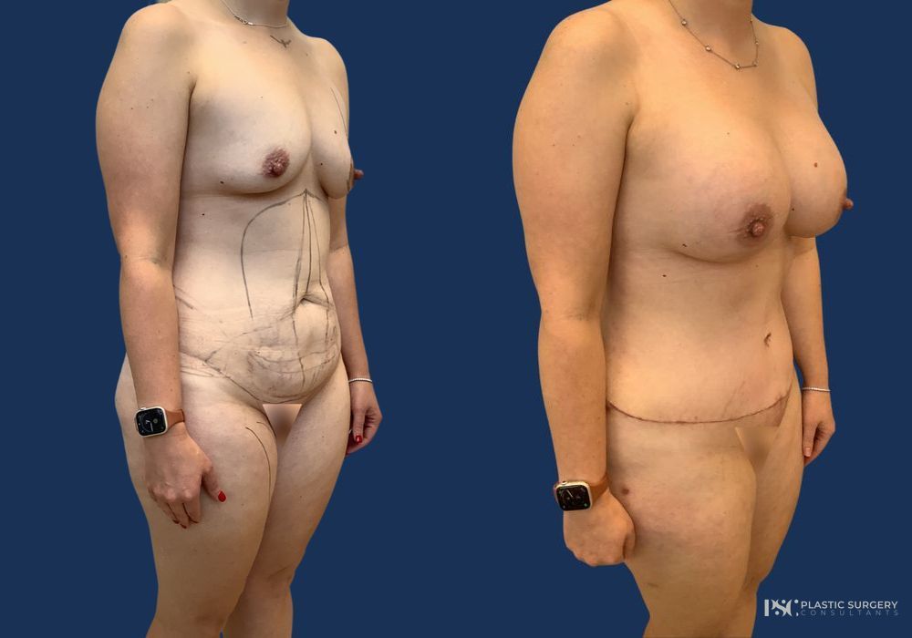Before and after Dr. Richard J. Wassermann case 26915 - Angle 2