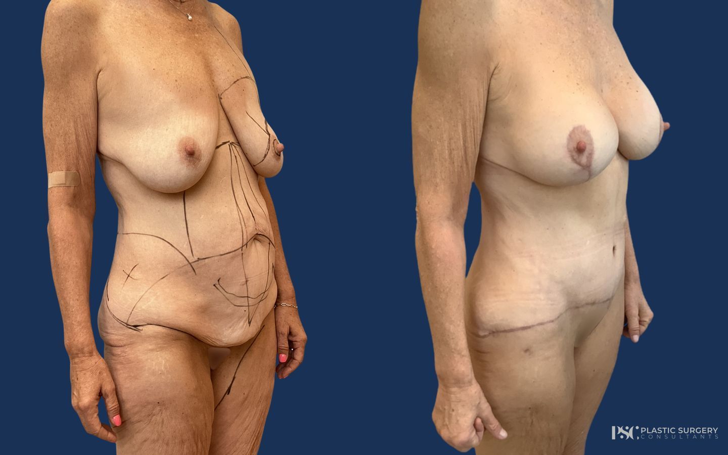 Before and after Combination Breast Surgery case 23881 - Angle 2