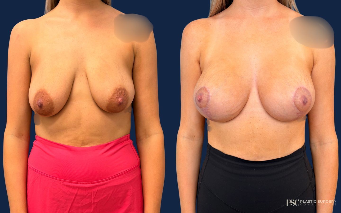 Before and after Breast Augmentation with Lift (Mastopexy Augmentation) case 49390