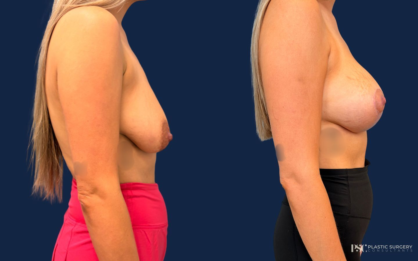 Before and after Breast Augmentation with Lift (Mastopexy Augmentation) case 49390 - Angle 2