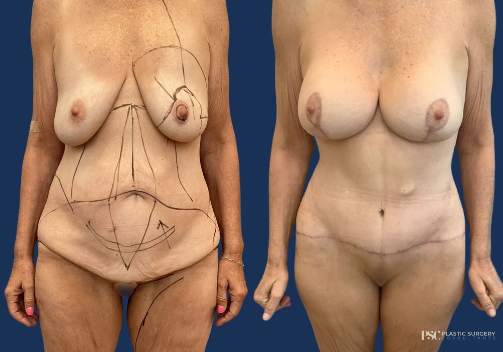 Before and after Dr. Richard J. Wassermann case 23881