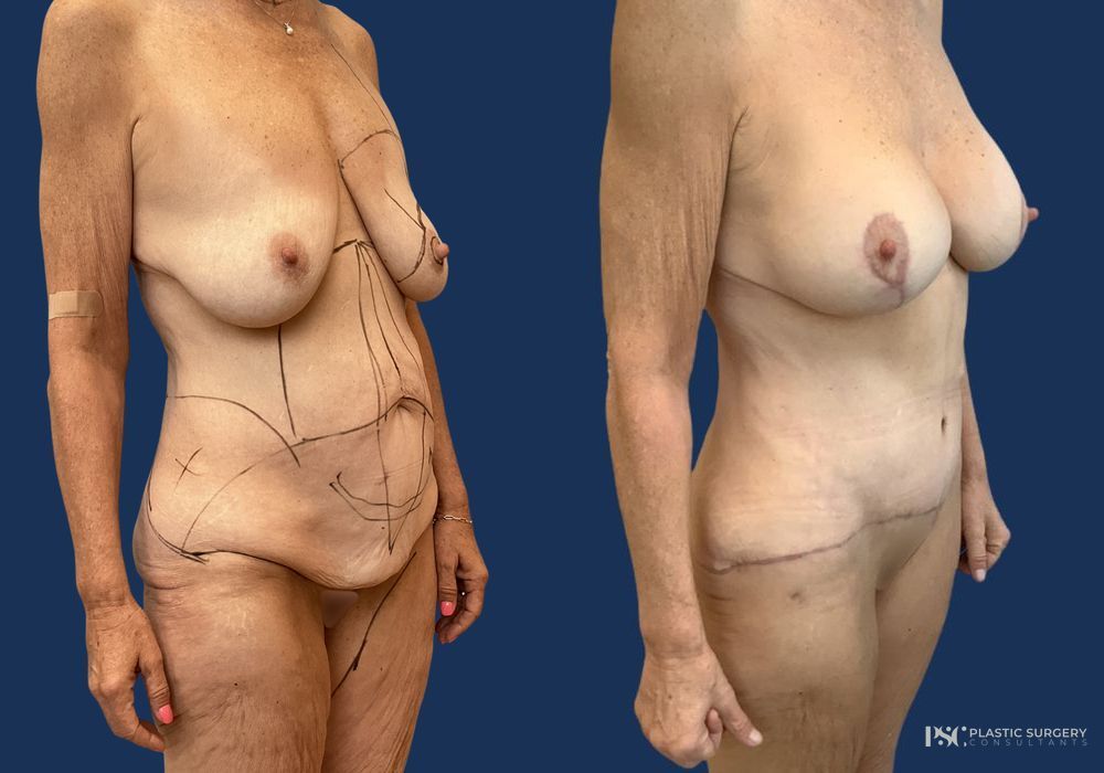Before and after Dr. Richard J. Wassermann case 23881 - Angle 2