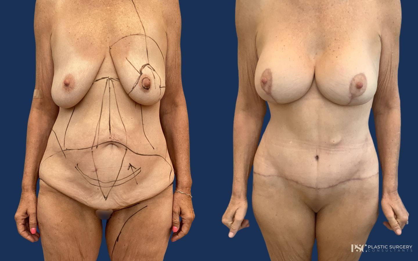 Before and after Mommy Makeover case 23881