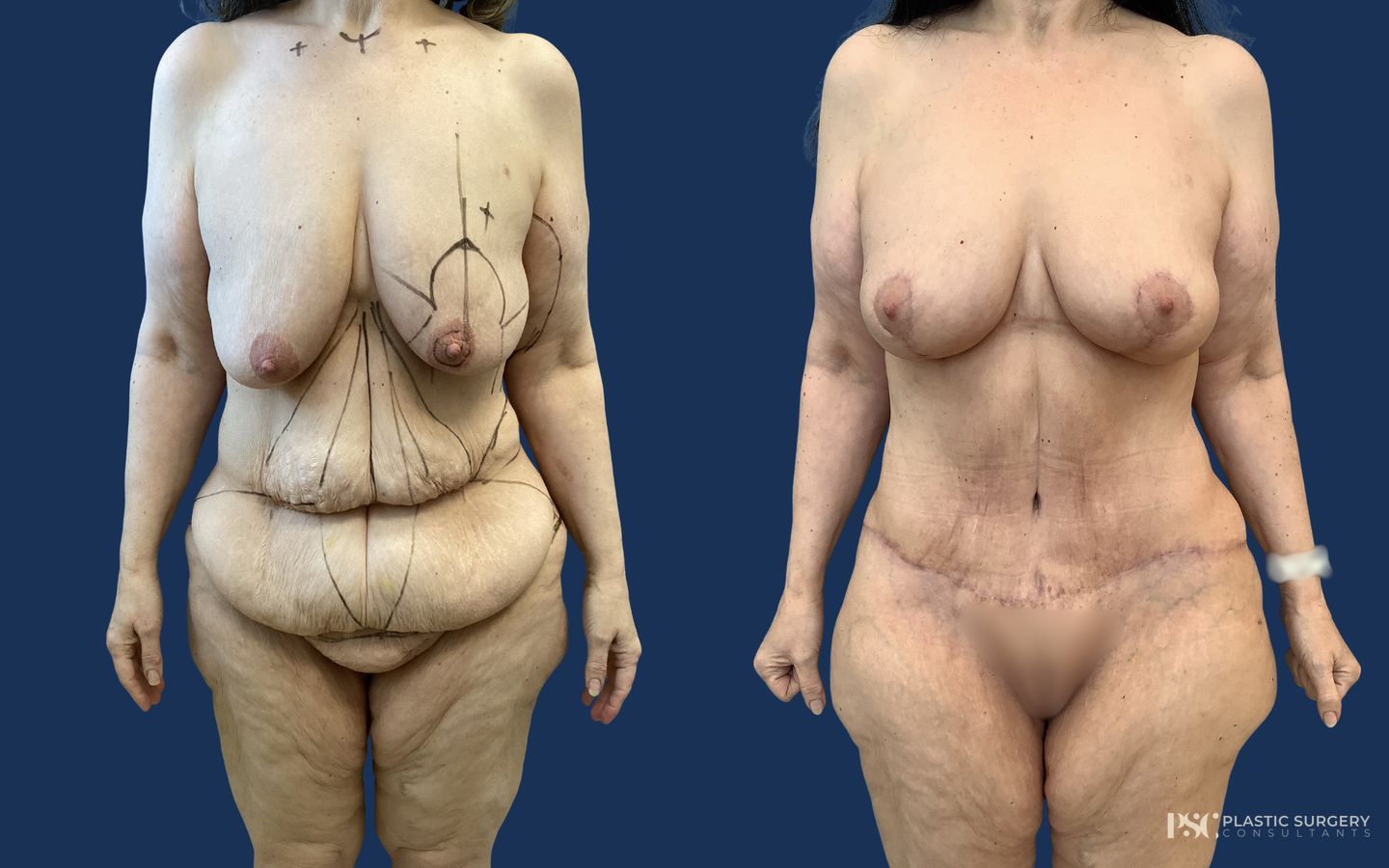 Before and after Breast Lift (Mastopexy) case 23874