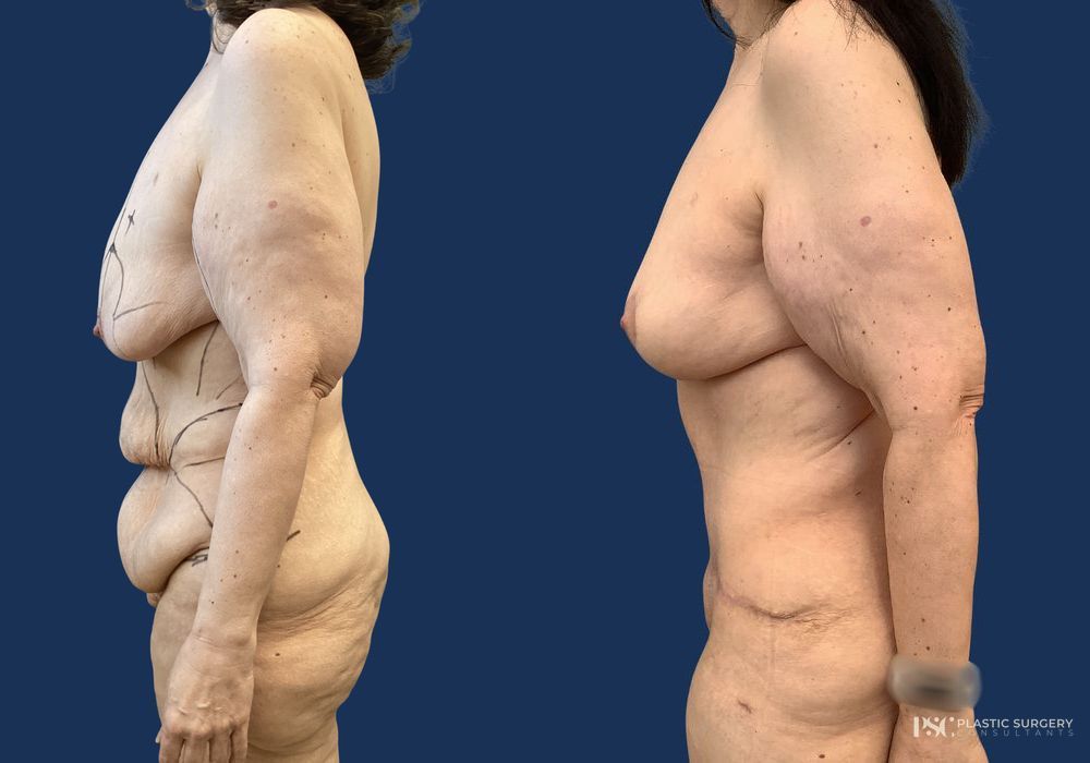 Before and after Complex Surgery case 23874 - Angle 2