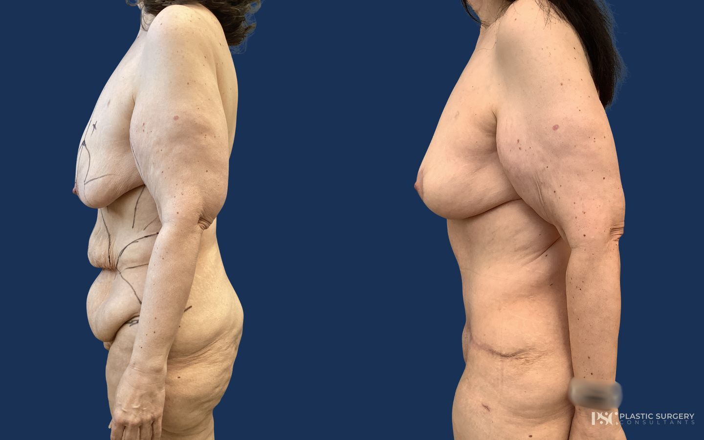 Before and after Combination Body Surgery case 23874 - Angle 2