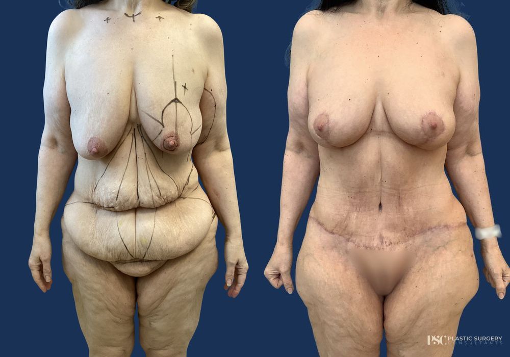 Before and after Complex Surgery case 23874