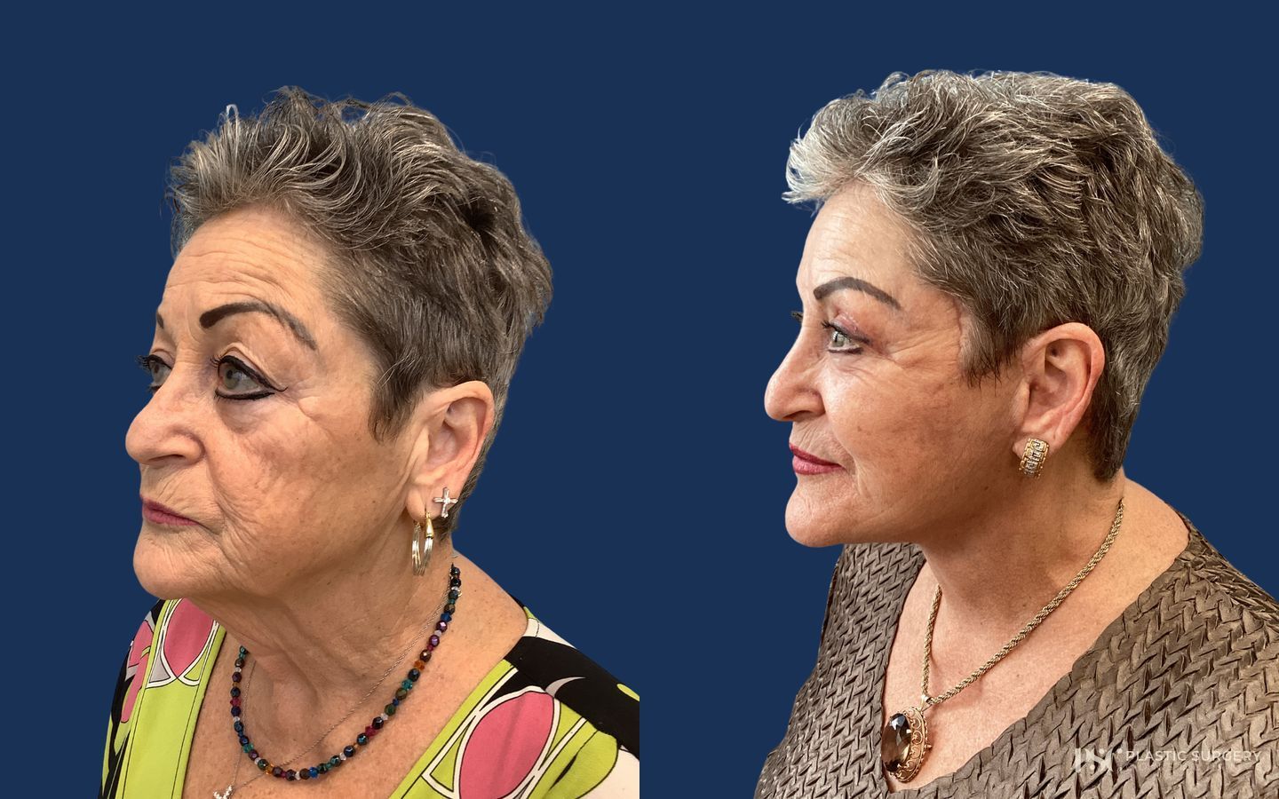 Before and after Peels & Facials case 26913 - Angle 3