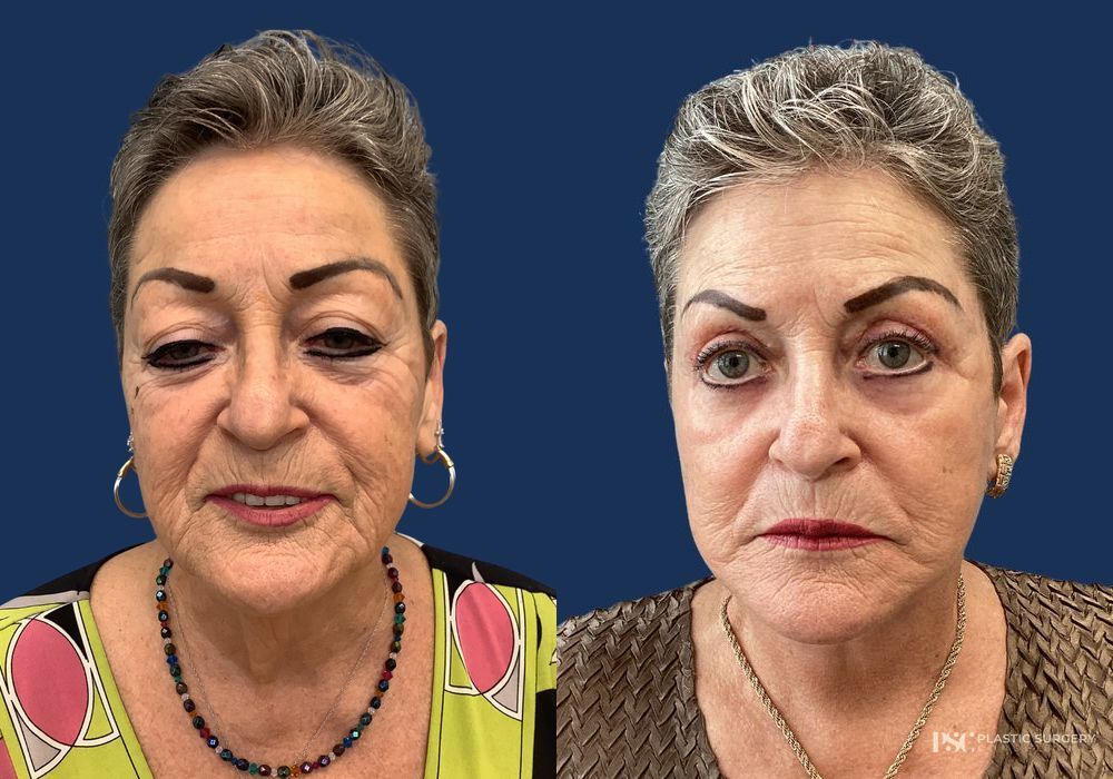 Before and after Dr. Richard J. Wassermann case 26913 - Angle 2