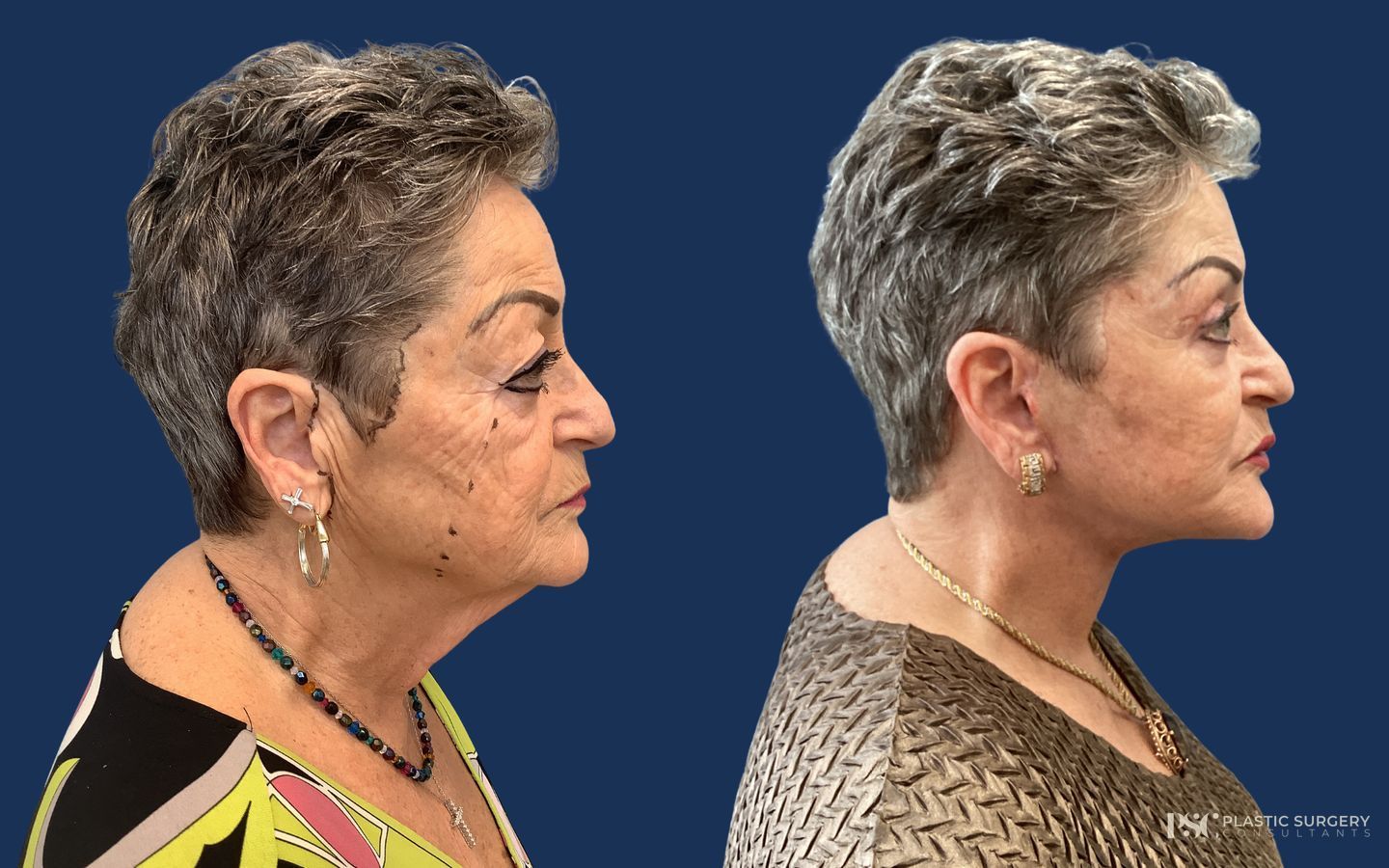 Before and after Peels & Facials case 26913