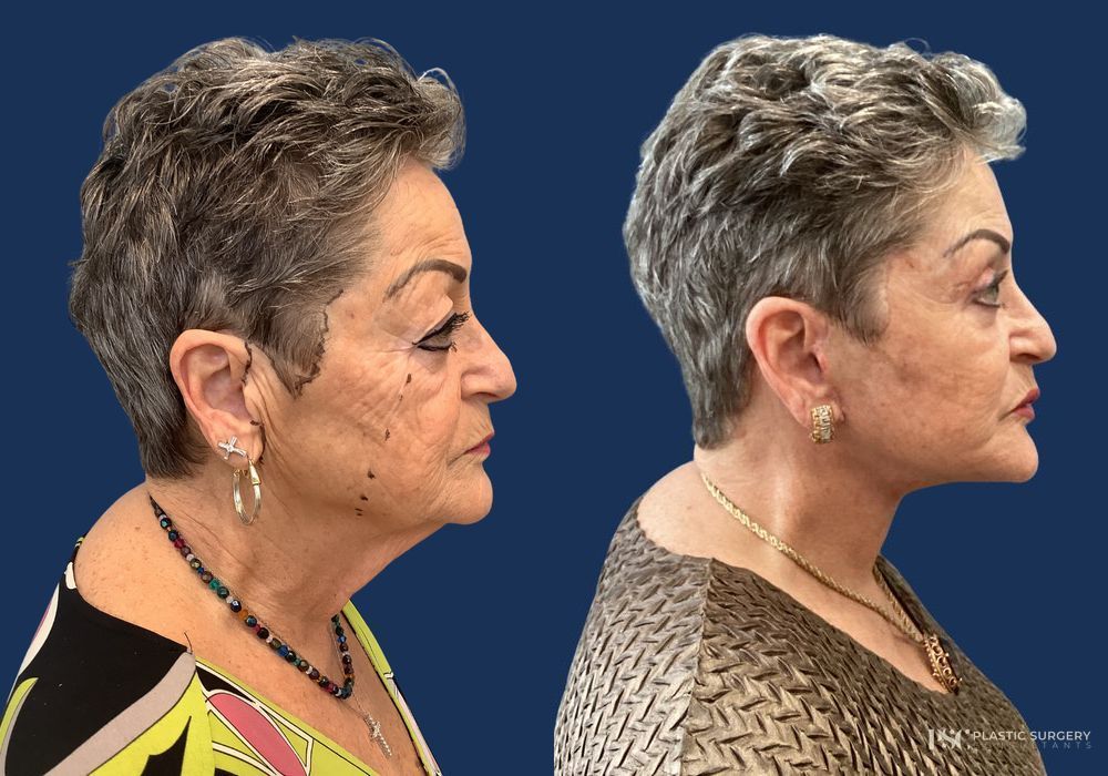 Before and after Dr. Richard J. Wassermann case 26913