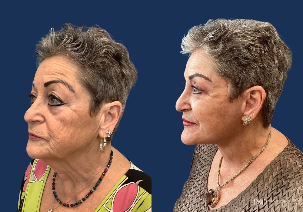 Before and after Dr. Richard J. Wassermann case 26913 - Angle 3