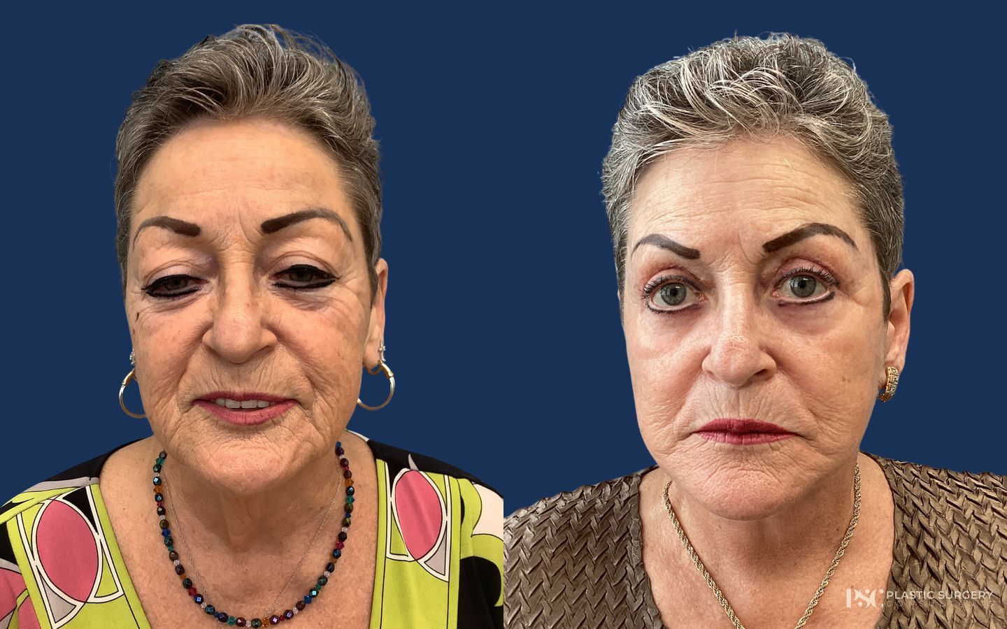 Before and after Peels & Facials case 26913 - Angle 2