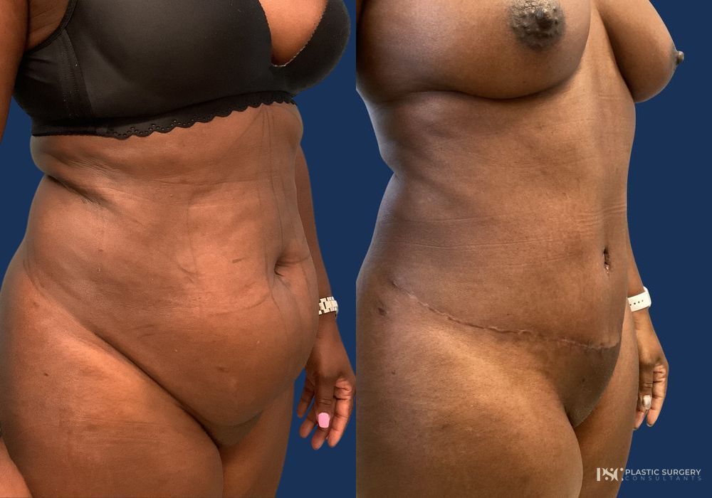 Before and after Dr. Richard J. Wassermann case 26248 - Angle 2