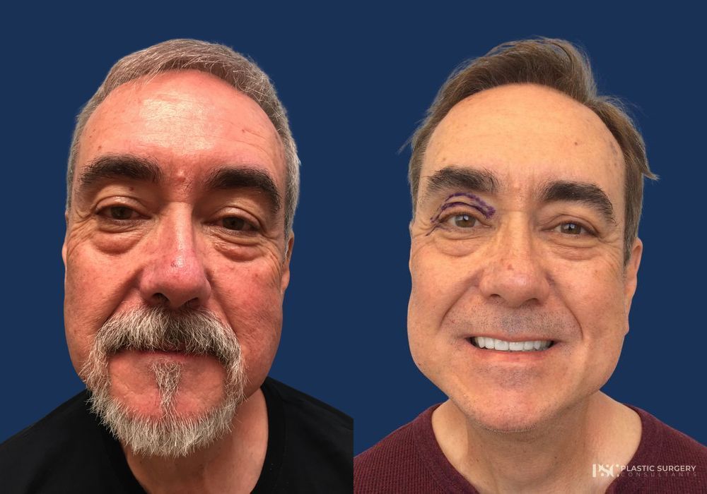 Before and after Dr. Richard J. Wassermann case 26914 - Angle 2
