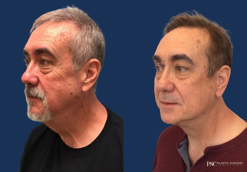 Before and after Dr. Richard J. Wassermann case 26914