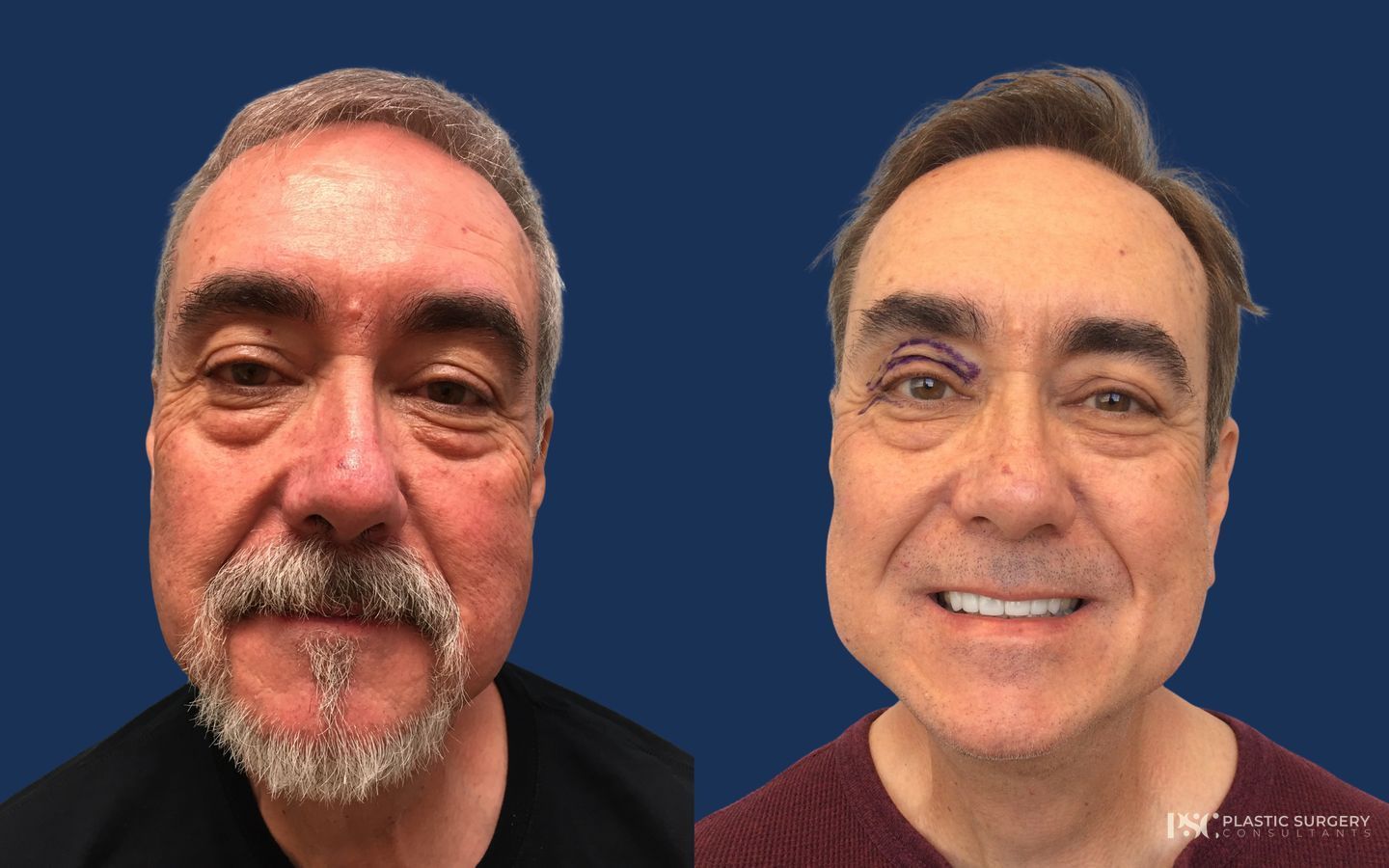 Before and after Peels & Facials case 26914 - Angle 2
