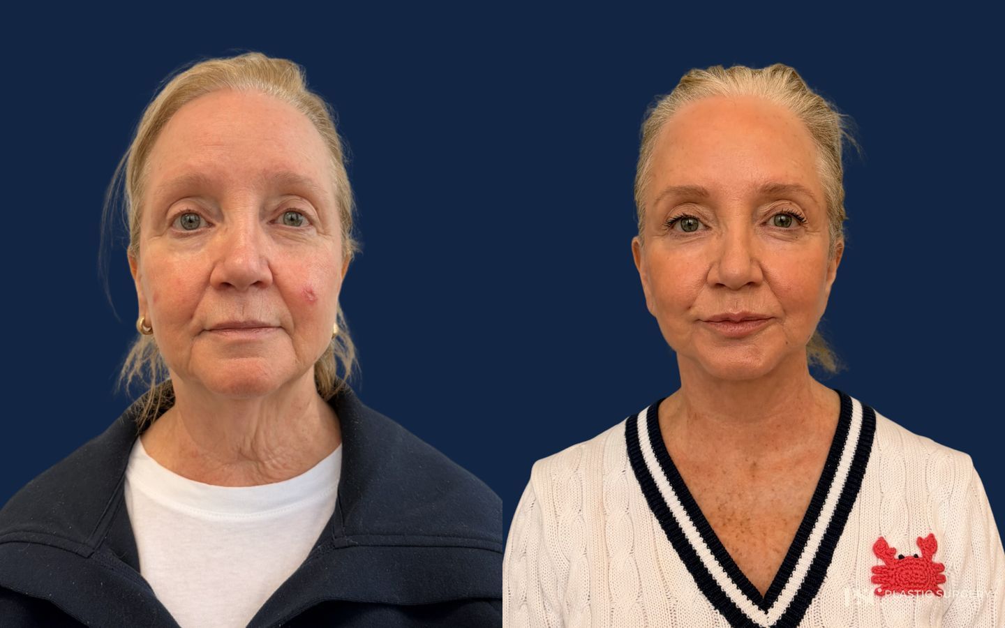 Before and after Facelift case 46774
