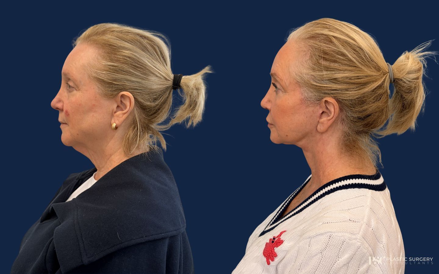 Before and after Facelift case 46774 - Angle 2