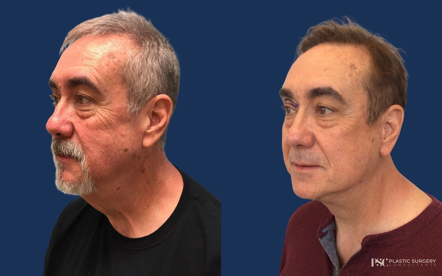 Before and after Peels & Facials case 26914