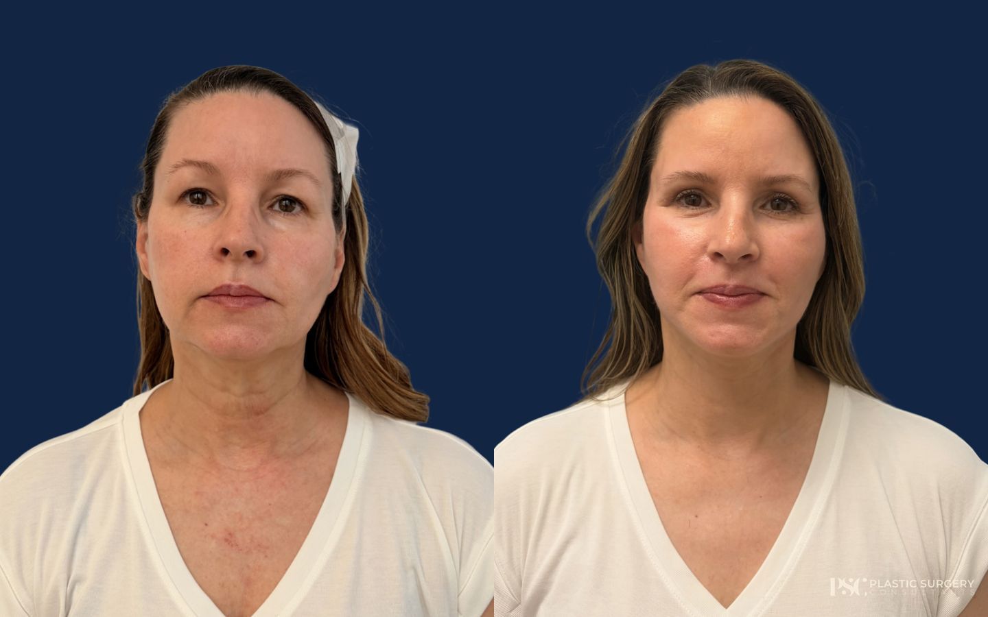 Before and after Blepharoplasty case 50199 - Angle 2
