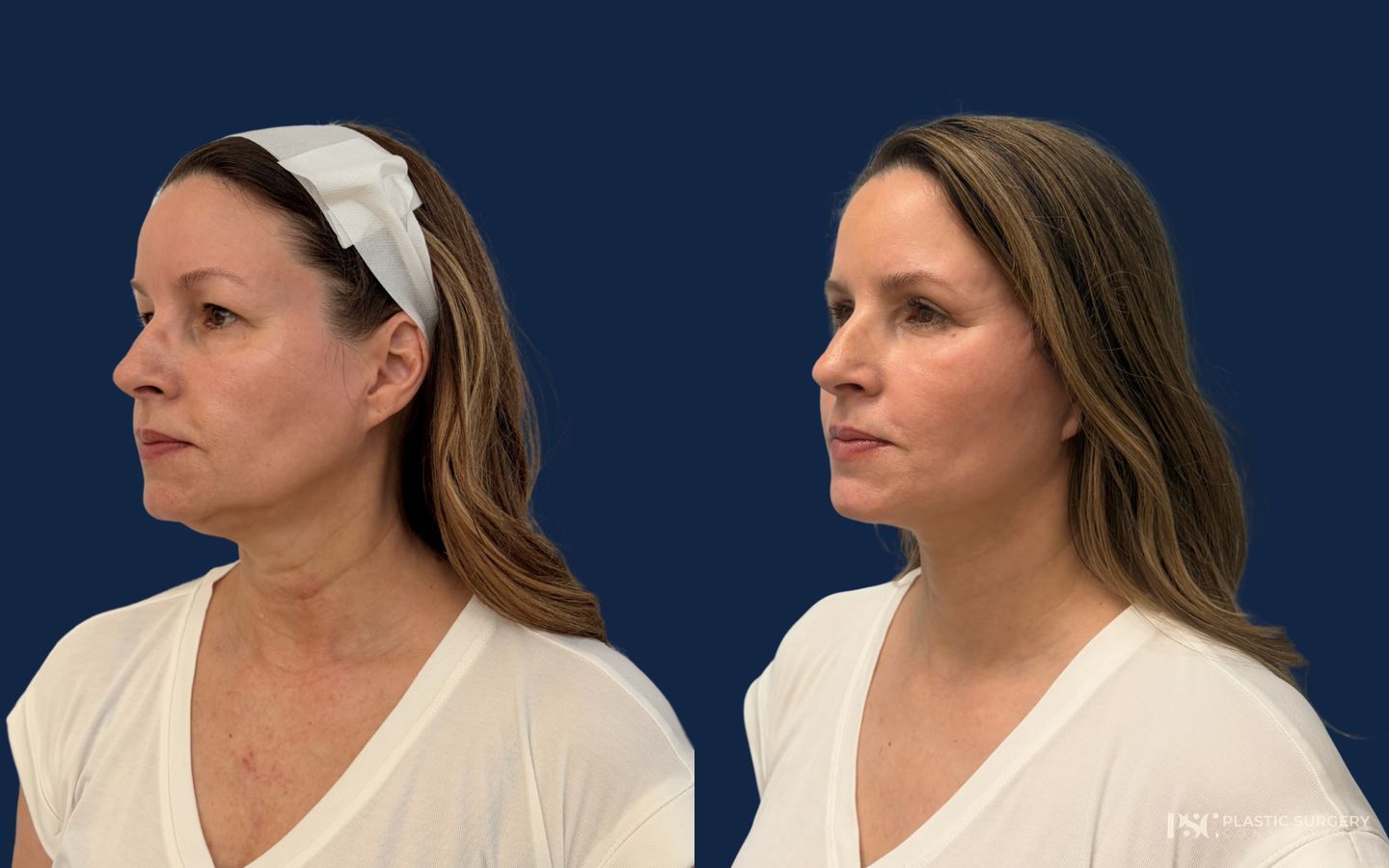 Before and after Blepharoplasty case 50199
