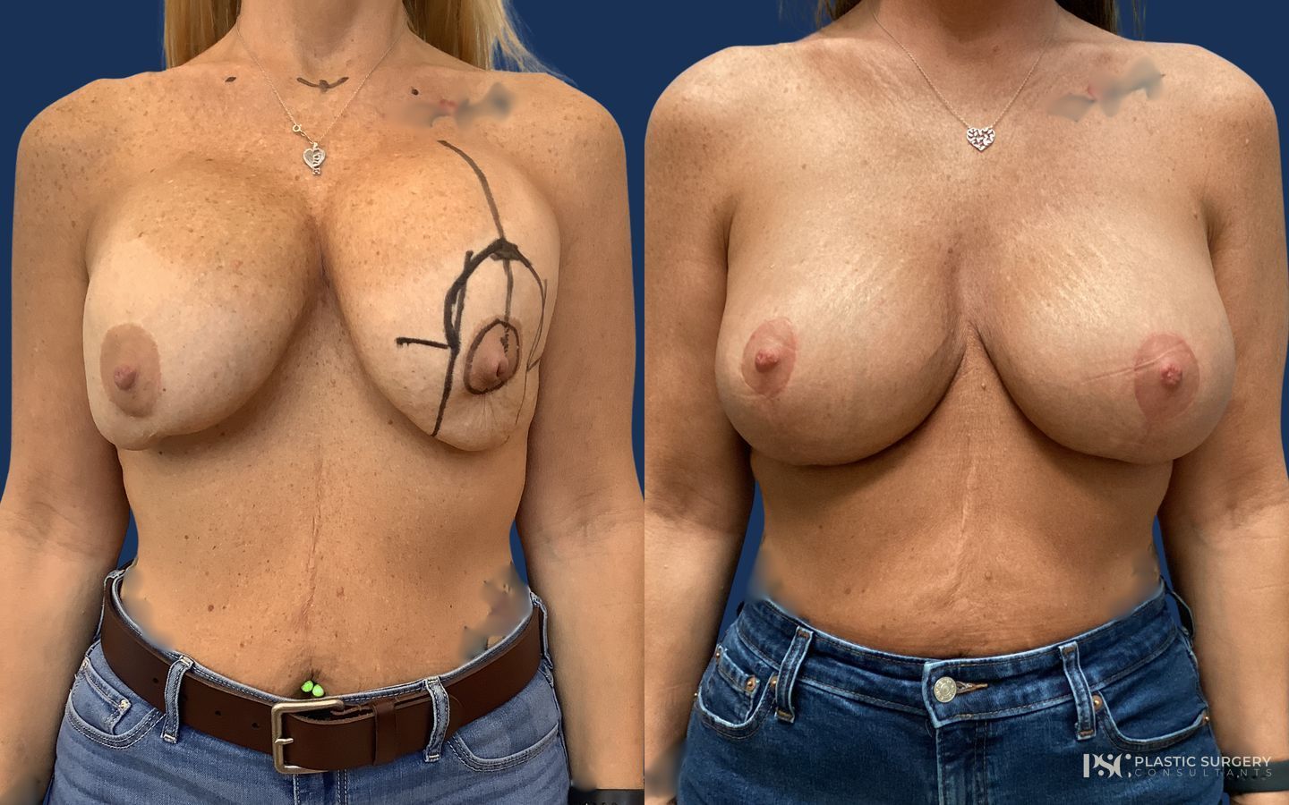 Before and after Implant Exchange case 23879
