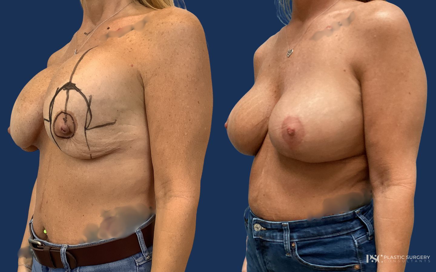 Before and after Implant Exchange case 23879 - Angle 2