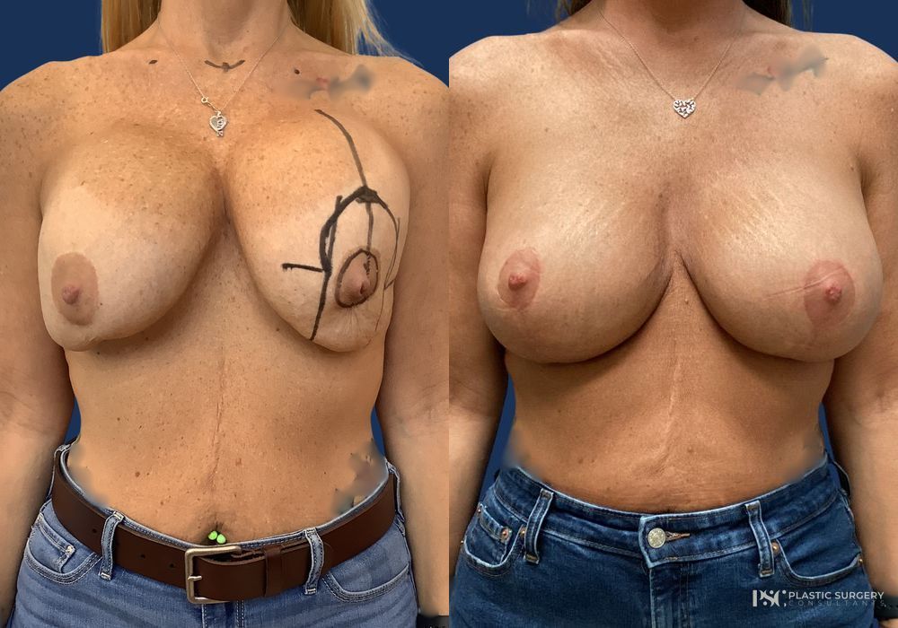 Before and after Complex Surgery case 23879
