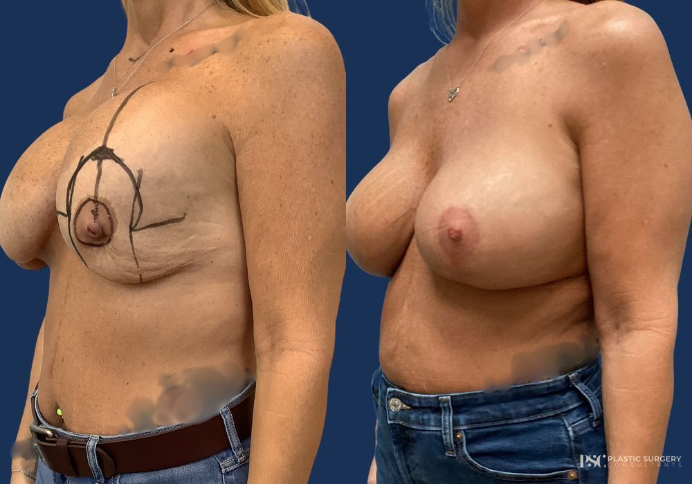 Before and after Complex Surgery case 23879 - Angle 2